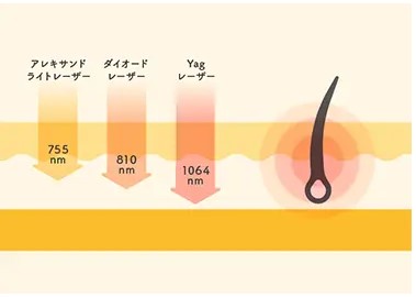 医療脱毛のレーザーの種類の比較表