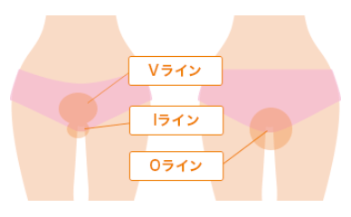 ドクター松井クリニック女性VIO脱毛料金と施術範囲