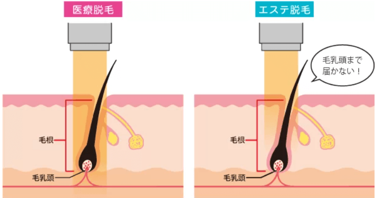 医療脱毛とエステサロンの脱毛の違い