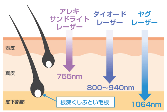 福岡博多駅前通中央クリニックの医療脱毛器で扱うレーザーの種類について説明です。