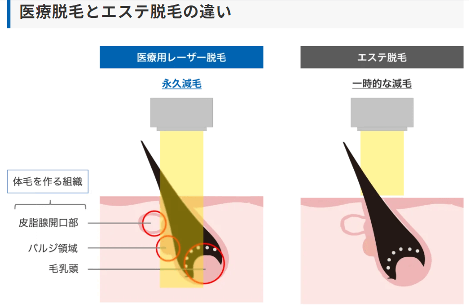 医療脱毛エステサロン脱毛効果違い