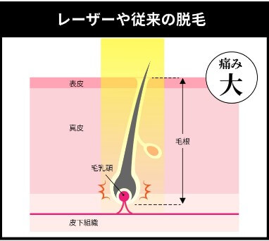 ラココLACOCO宮崎ナナイロ店IPL方式